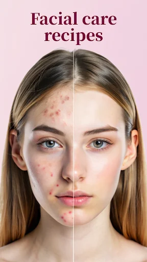 Before and after facial skin care transformation showing acne reduction and clear skin results